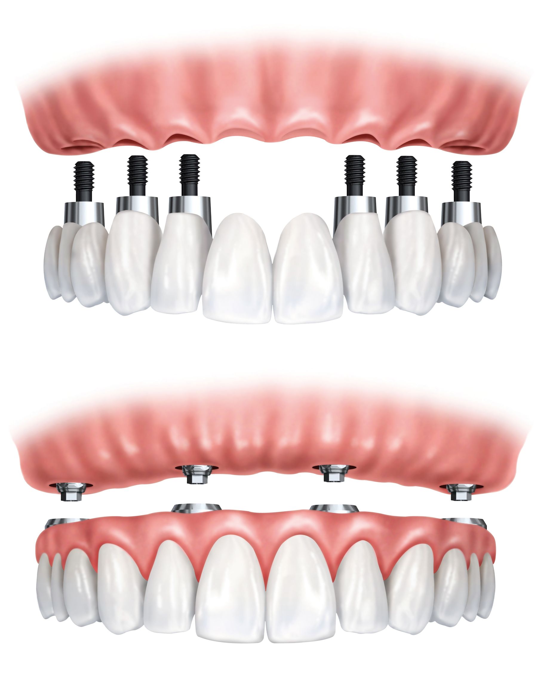 Do You Need a Tooth Implant in Bethesda MD?