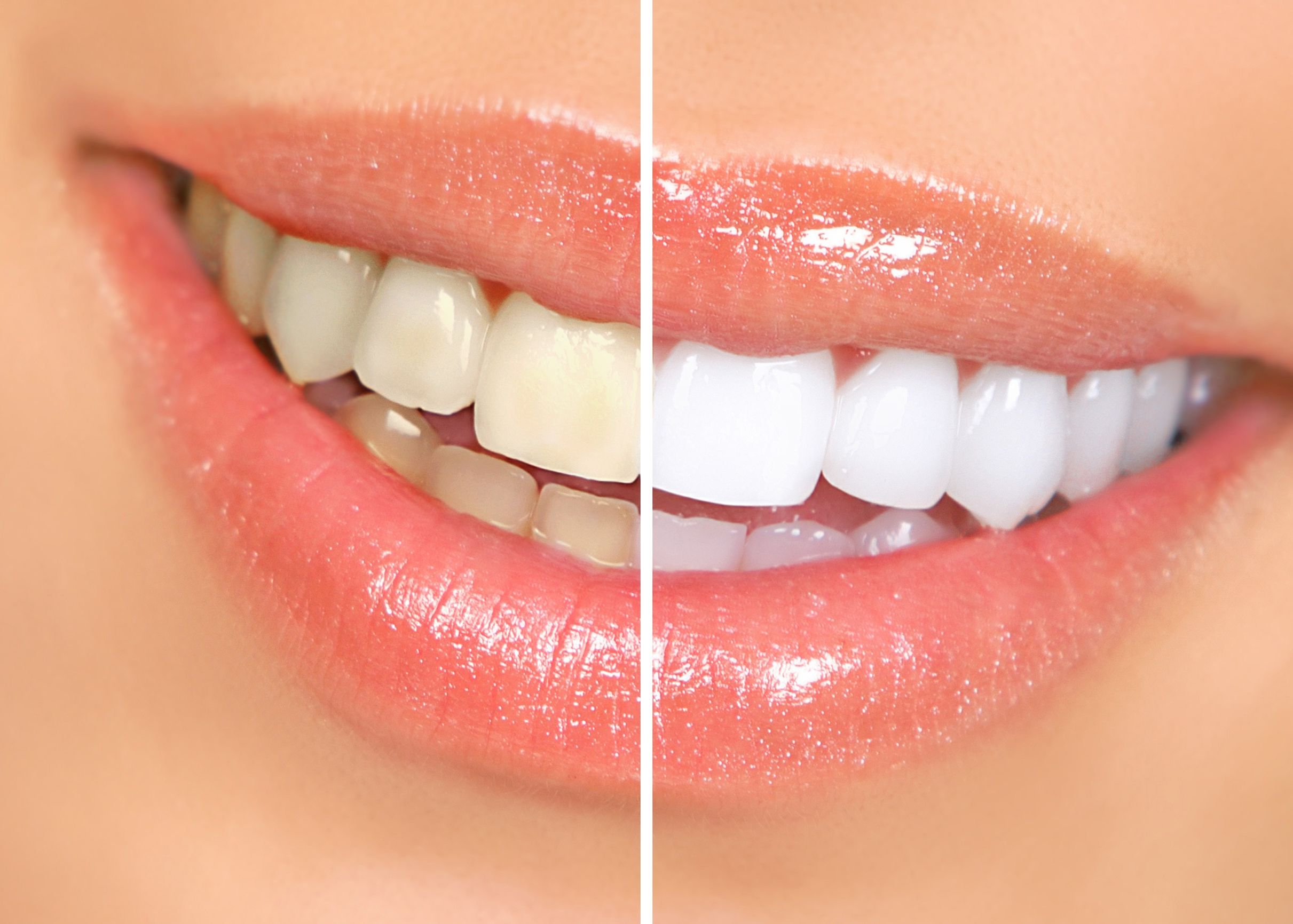 Dentists Use Veneers in Keizer, OR to Create a Beautiful Smile