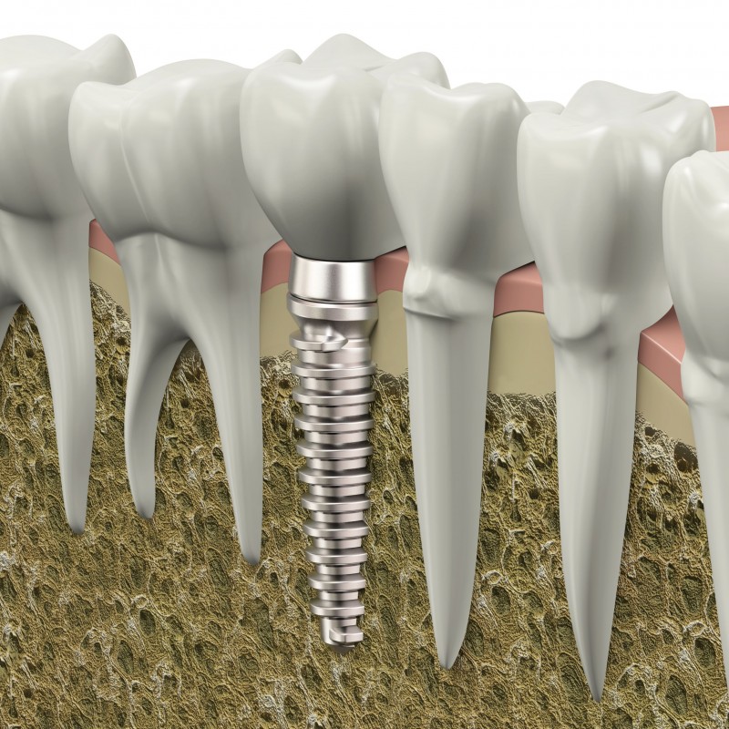 Why You Should Acquire Dental Implants In Queens, NY